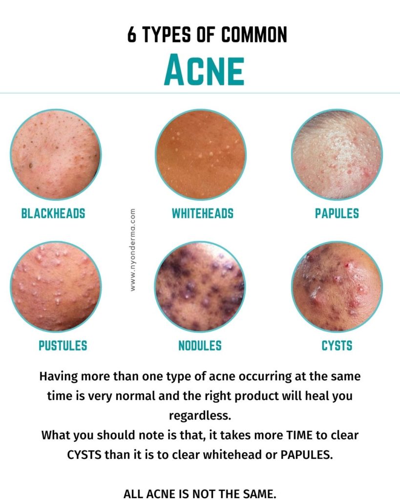 pimples. blackhead, whitehead, cystic acne, nodules and types of acne treated by nyon derma