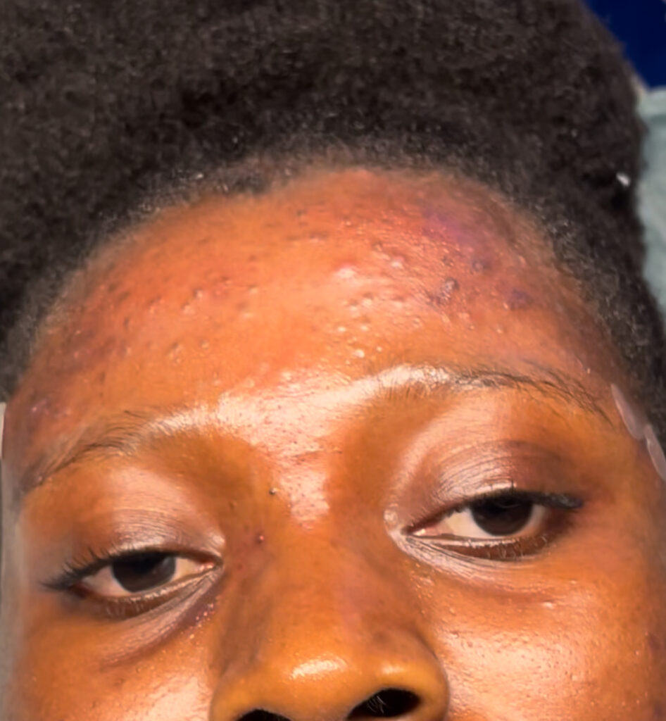 Forehead acne in African skin